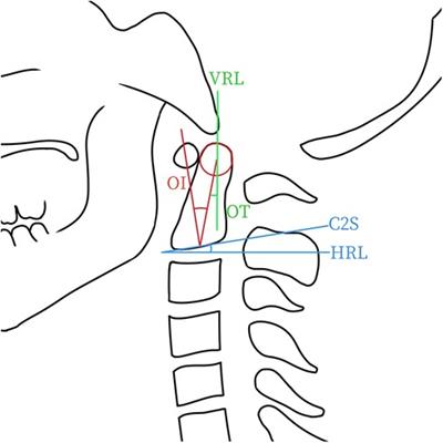 Analysis of odontoid parameters in adolescent idiopathic scoliosis patients with different curve types